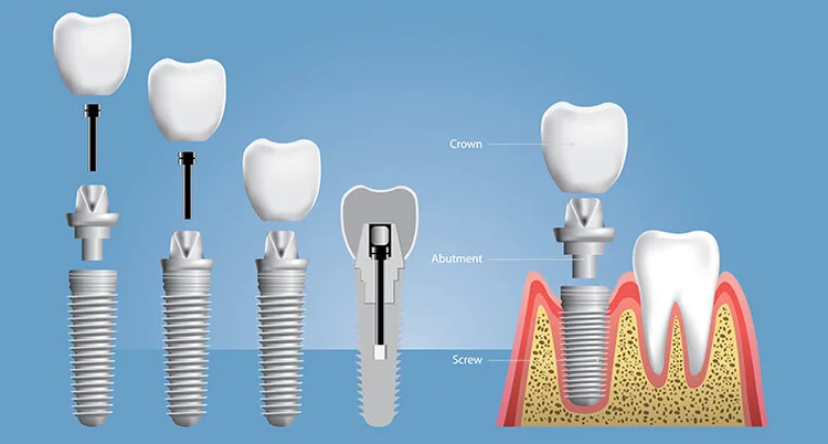 Dental Implant 1