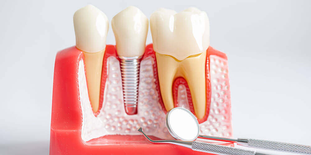Dental Implants