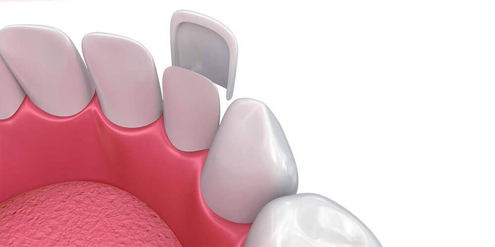 Dental Veneers Winchester