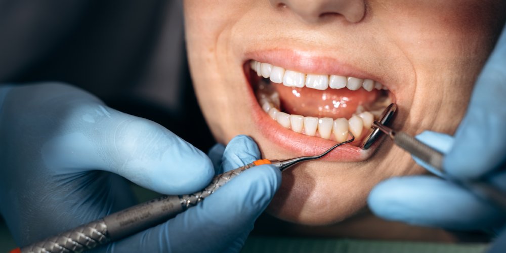 Root Planing Winchester