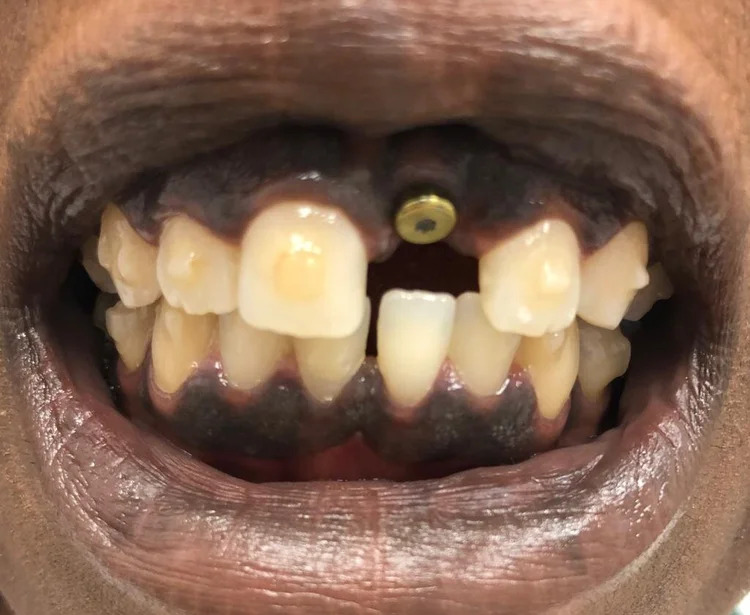 Gallery Before Image 4