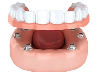 Implant Supported Dentures 1